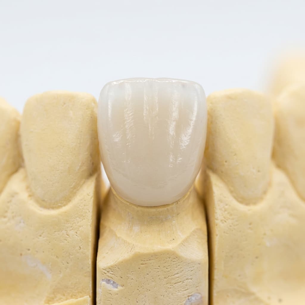 Custom Dental Crown