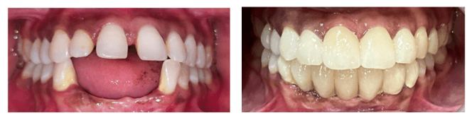 Patient Before and After Transformation