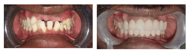 Patient Before and After Transformation